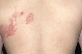 “最疼皮膚病”進入高發期 出現這些疼痛信號別大意